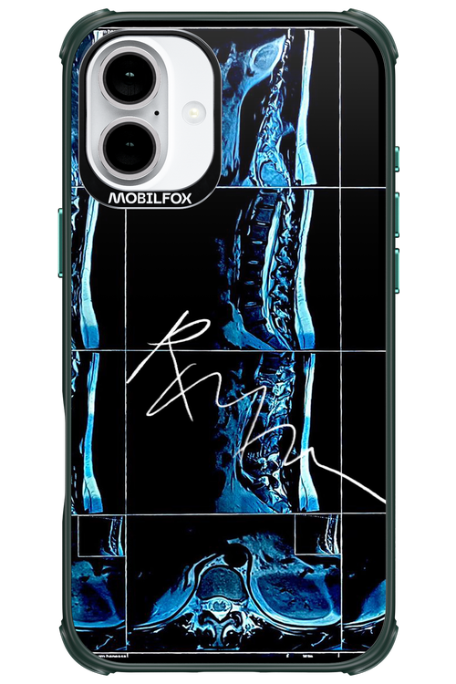 RMN Scolioza 2.0 - Apple iPhone 16 Plus