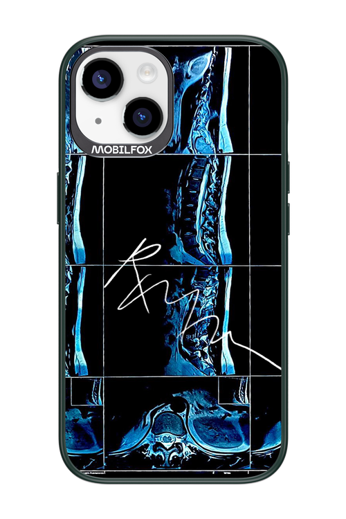 RMN Scolioza 2.0 - Apple iPhone 14