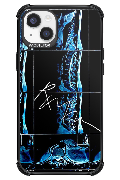 RMN Scolioza 2.0 - Apple iPhone 14 Plus
