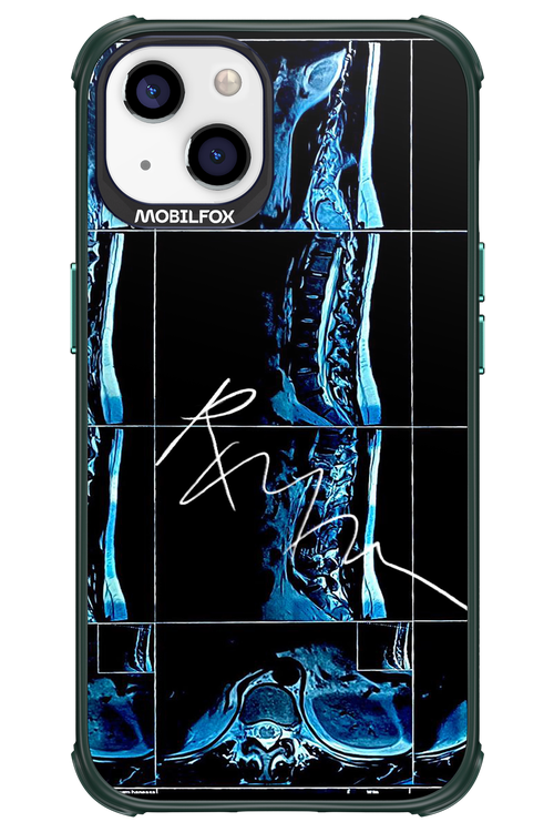 RMN Scolioza 2.0 - Apple iPhone 13