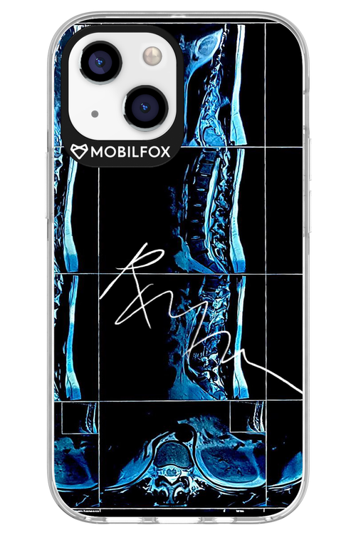 RMN Scolioza 2.0 - Apple iPhone 13 Mini