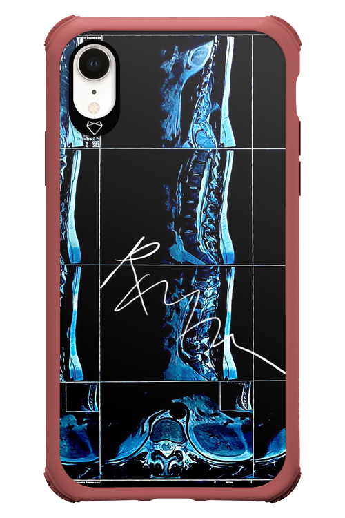 RMN Scolioza 2.0 - Apple iPhone XR