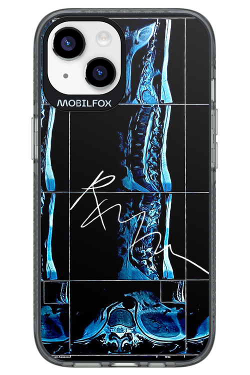 RMN Scolioza 2.0 - Apple iPhone 14