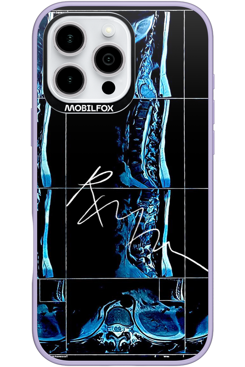 RMN Scolioza 2.0 - Apple iPhone 16 Pro Max