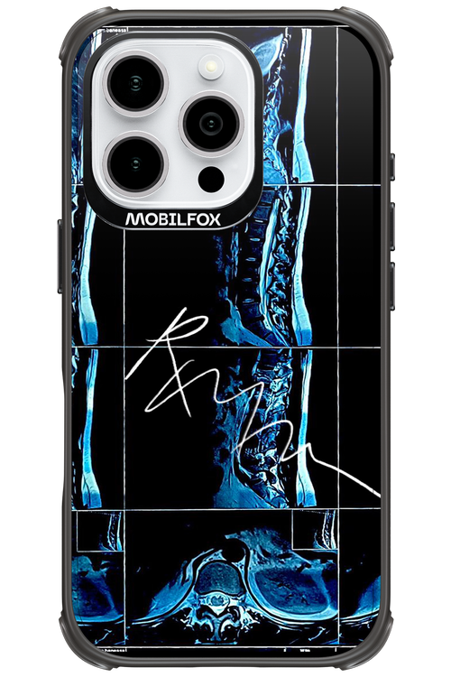 RMN Scolioza 2.0 - Apple iPhone 16 Pro