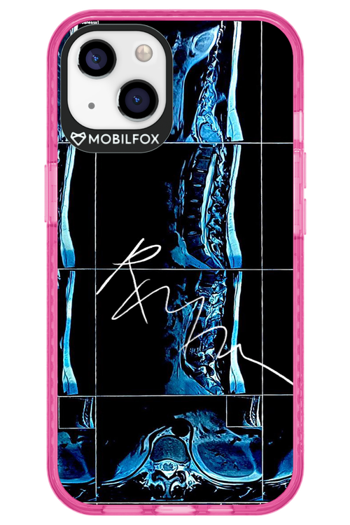 RMN Scolioza 2.0 - Apple iPhone 13