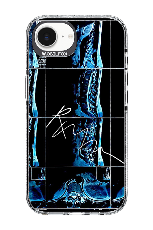 RMN Scolioza 2.0 - Apple iPhone 16e
