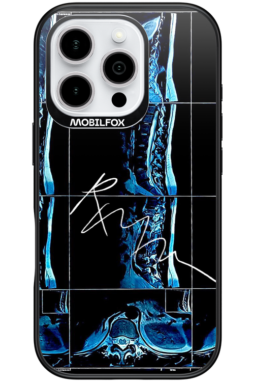 RMN Scolioza 2.0 - Apple iPhone 16 Pro