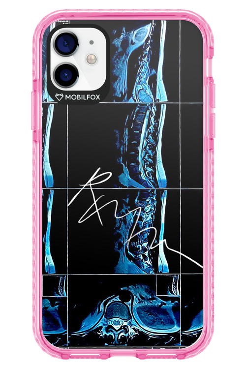 RMN Scolioza 2.0 - Apple iPhone 11