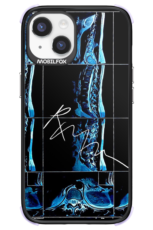 RMN Scolioza 2.0 - Apple iPhone 14