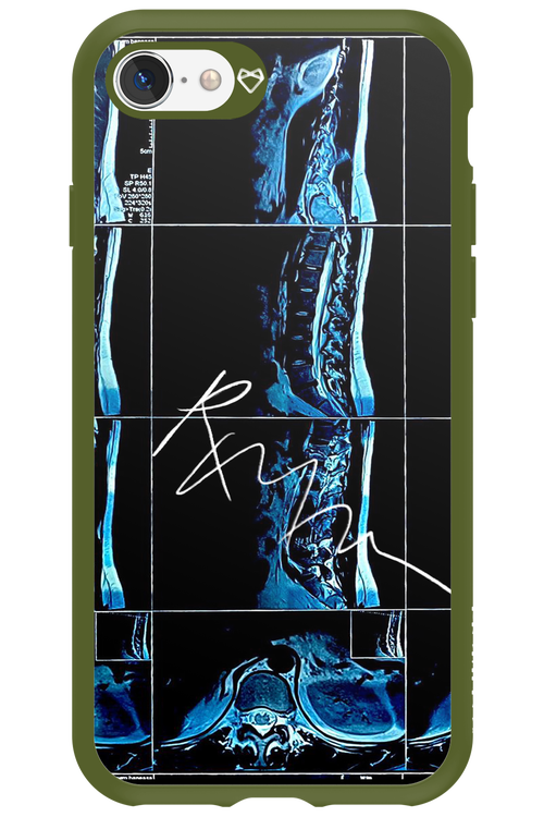 RMN Scolioza 2.0 - Apple iPhone 8