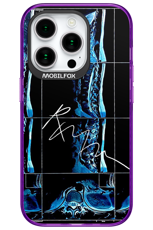 RMN Scolioza 2.0 - Apple iPhone 15 Pro