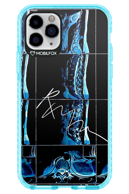 RMN Scolioza 2.0 - Apple iPhone 11 Pro