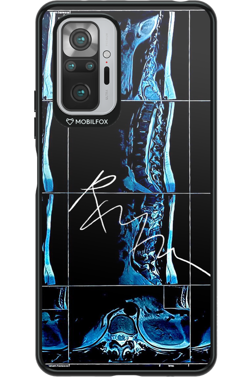 RMN Scolioza - Xiaomi Redmi Note 10S