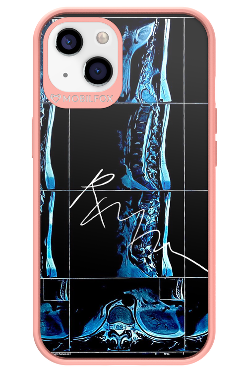 RMN Scolioza 2.0 - Apple iPhone 13
