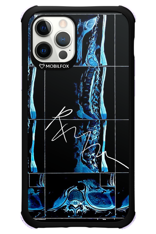 RMN Scolioza 2.0 - Apple iPhone 12 Pro