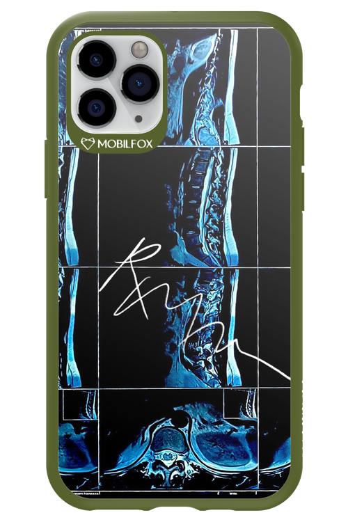 RMN Scolioza 2.0 - Apple iPhone 11 Pro