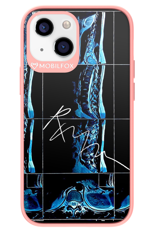 RMN Scolioza 2.0 - Apple iPhone 13 Mini