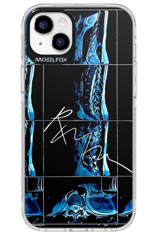 RMN Scolioza 2.0 - Apple iPhone 14 Plus