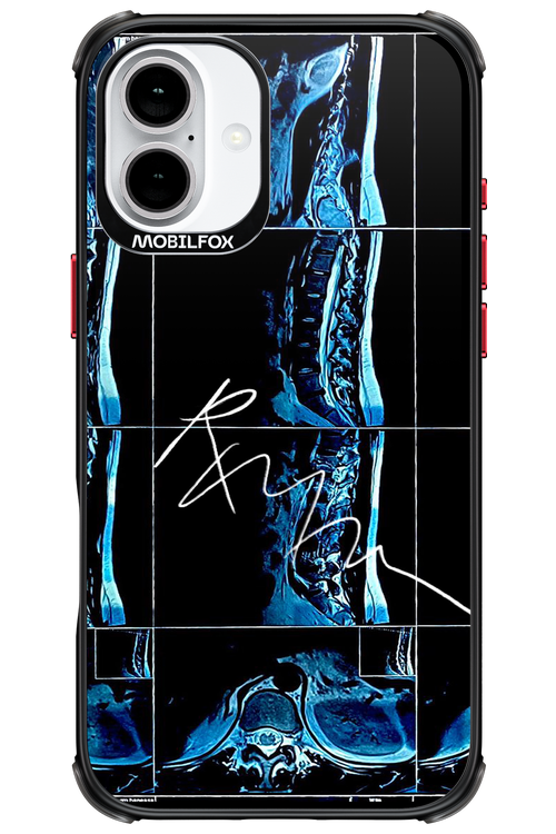 RMN Scolioza 2.0 - Apple iPhone 16 Plus