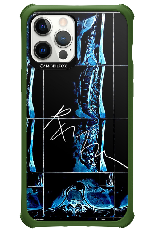 RMN Scolioza 2.0 - Apple iPhone 12 Pro Max