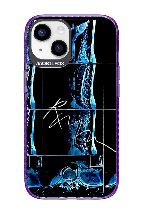 RMN Scolioza 2.0 - Apple iPhone 14