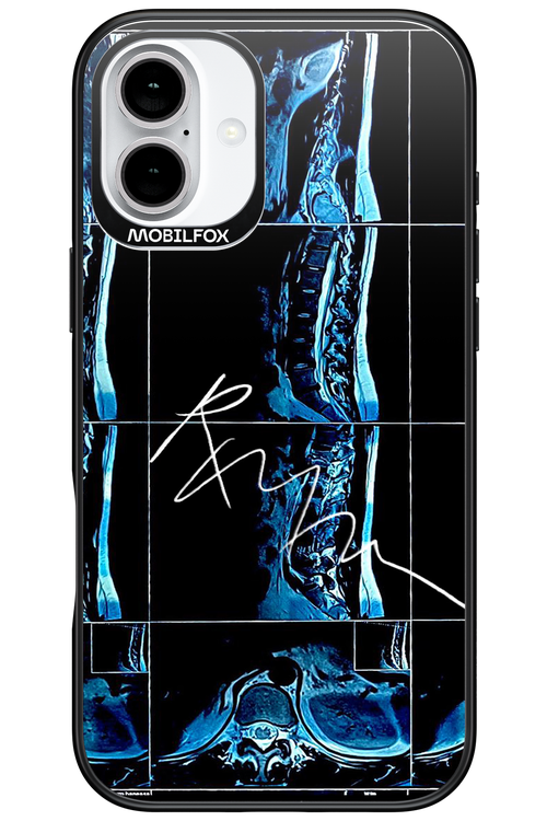 RMN Scolioza 2.0 - Apple iPhone 16 Plus