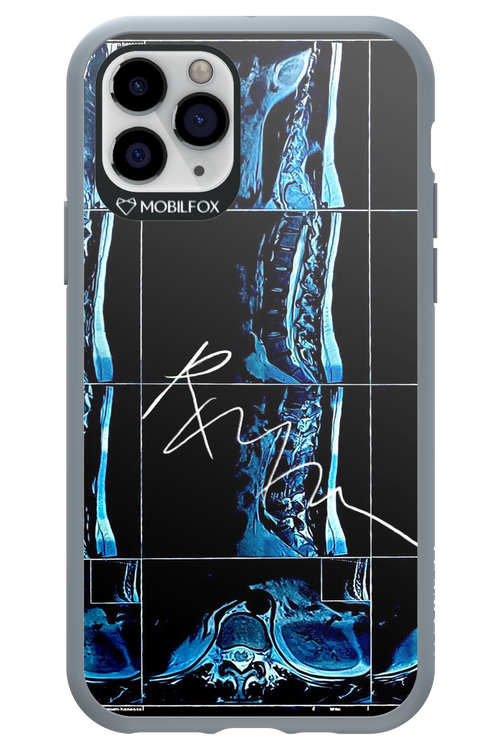 RMN Scolioza 2.0 - Apple iPhone 11 Pro