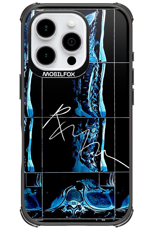 RMN Scolioza 2.0 - Apple iPhone 16 Pro