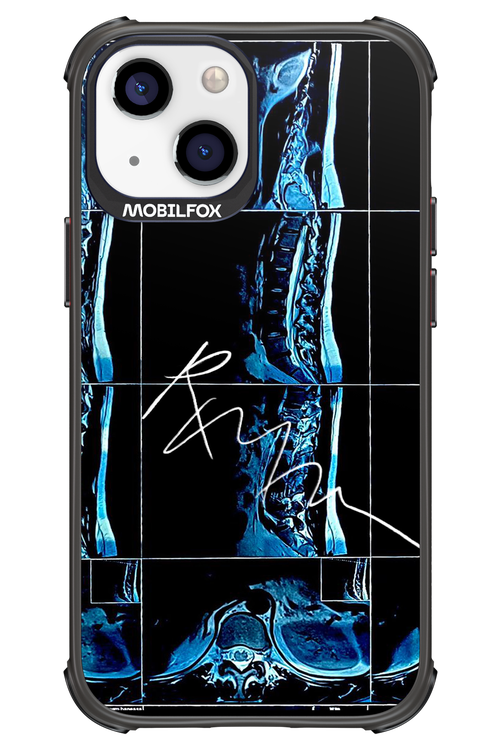 RMN Scolioza 2.0 - Apple iPhone 13 Mini