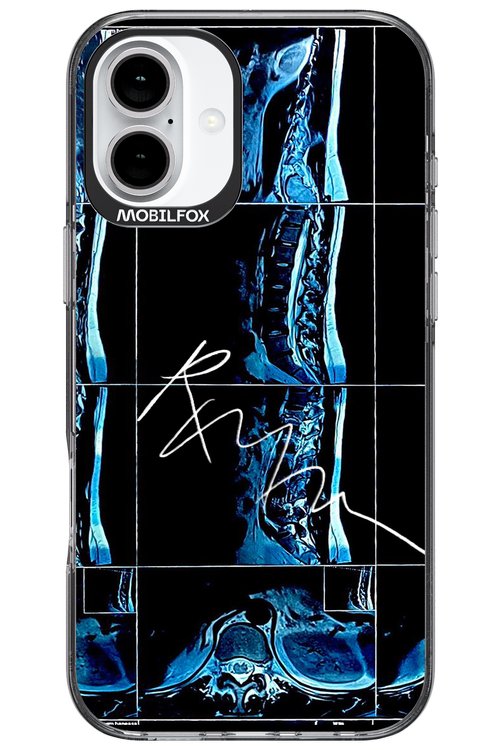 RMN Scolioza 2.0 - Apple iPhone 16 Plus