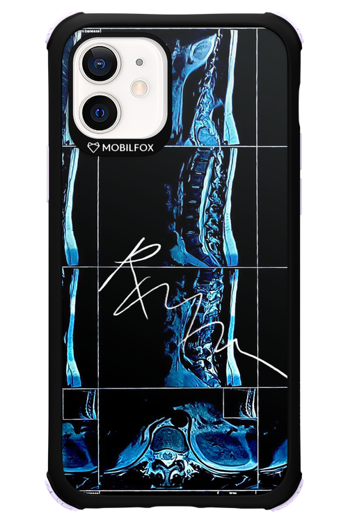 RMN Scolioza 2.0 - Apple iPhone 12