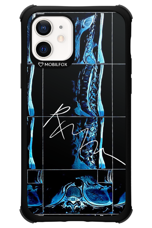 RMN Scolioza 2.0 - Apple iPhone 12