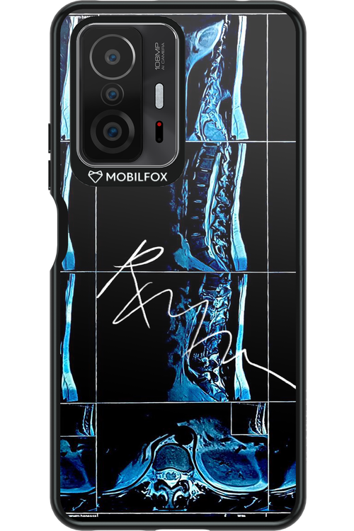RMN Scolioza 2.0 - Xiaomi Mi 11T Pro