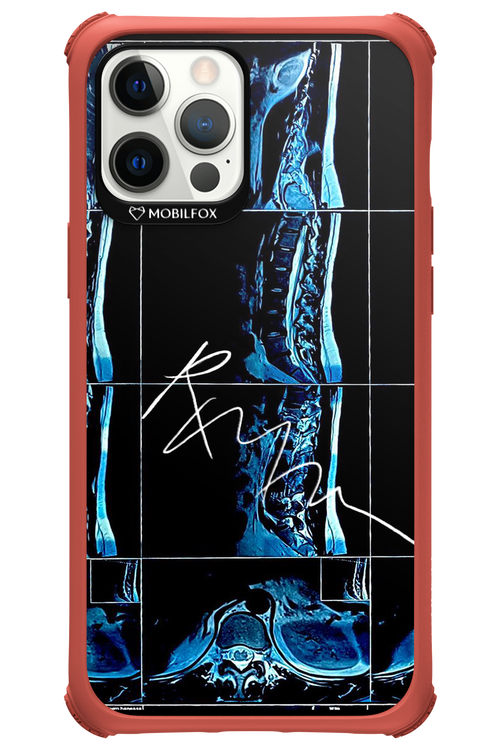 RMN Scolioza 2.0 - Apple iPhone 12 Pro Max
