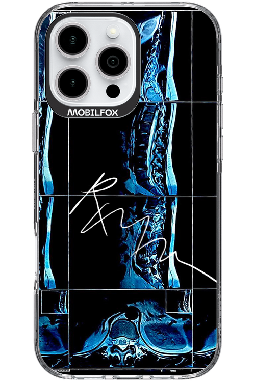 RMN Scolioza 2.0 - Apple iPhone 16 Pro Max