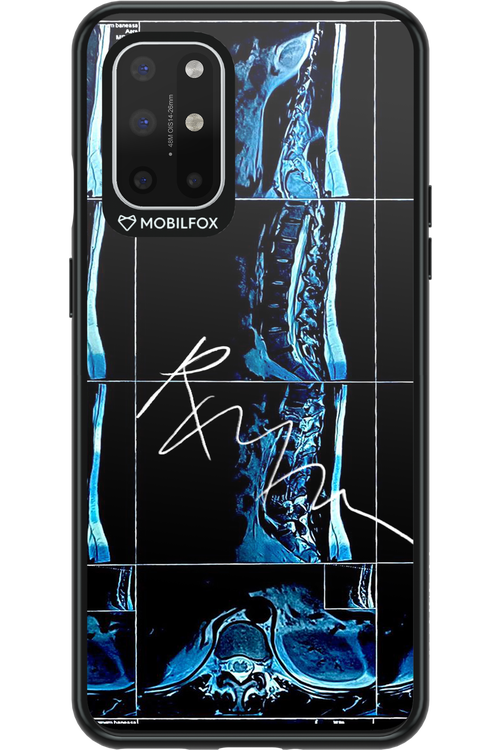 RMN Scolioza 2.0 - OnePlus 8T