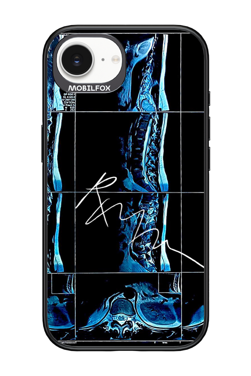 RMN Scolioza 2.0 - Apple iPhone 17e