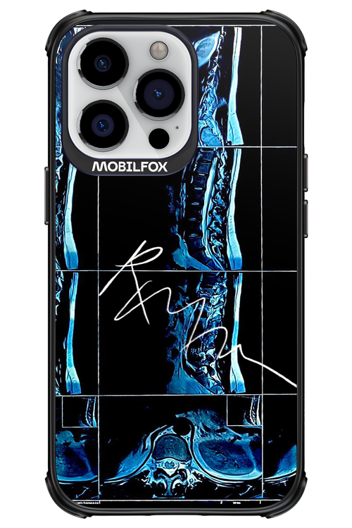 RMN Scolioza 2.0 - Apple iPhone 13 Pro