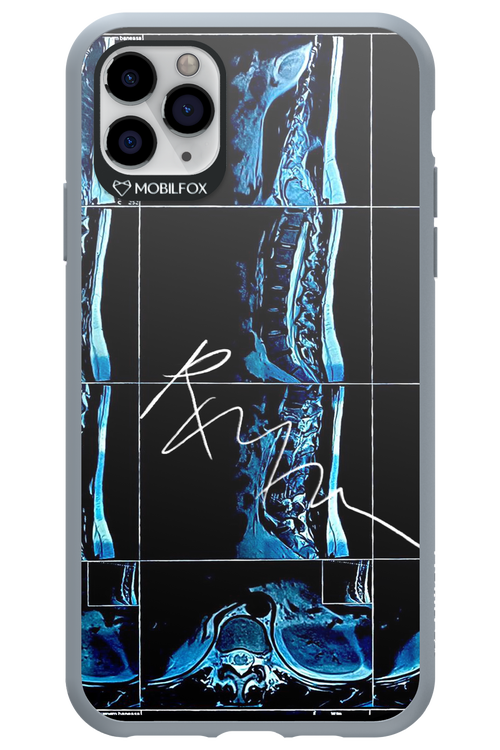 RMN Scolioza 2.0 - Apple iPhone 11 Pro Max