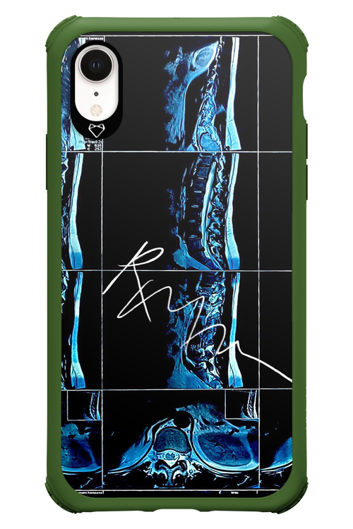 RMN Scolioza 2.0 - Apple iPhone XR