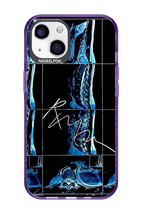 RMN Scolioza 2.0 - Apple iPhone 13