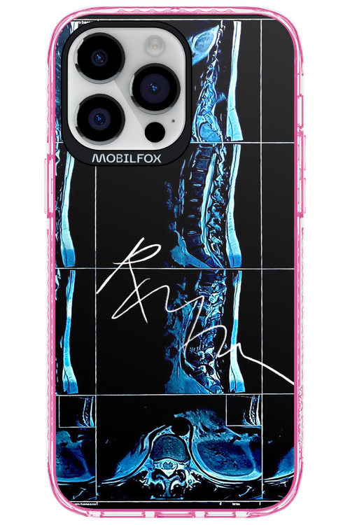 RMN Scolioza 2.0 - Apple iPhone 14 Pro Max