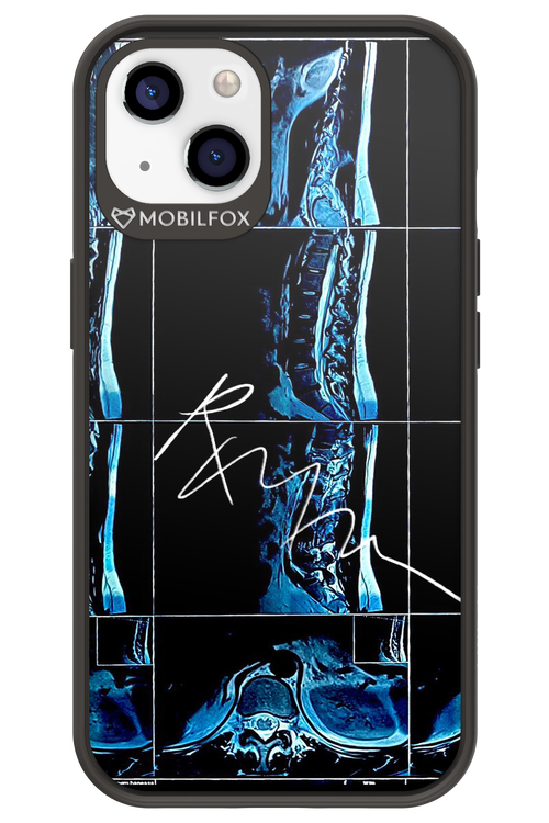 RMN Scolioza 2.0 - Apple iPhone 13