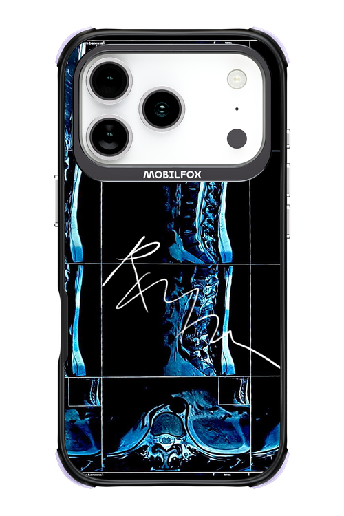 RMN Scolioza 2.0 - Apple iPhone 17 Pro