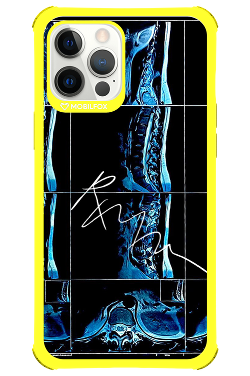 RMN Scolioza 2.0 - Apple iPhone 12 Pro Max