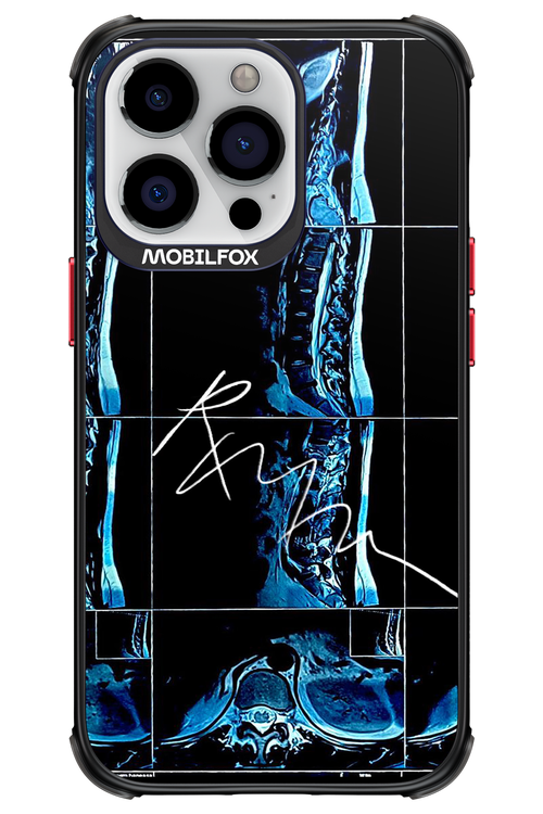 RMN Scolioza 2.0 - Apple iPhone 13 Pro