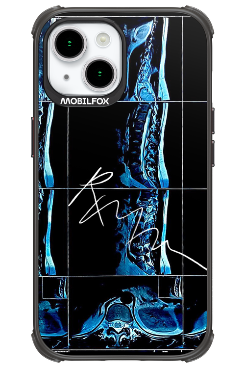 RMN Scolioza 2.0 - Apple iPhone 15