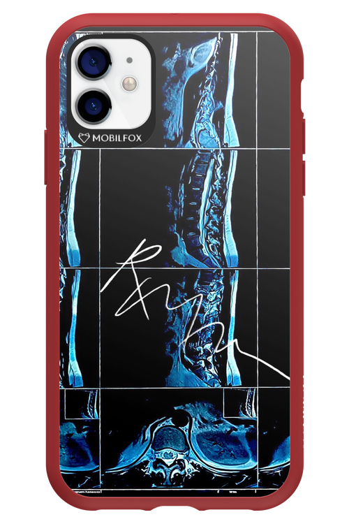 RMN Scolioza 2.0 - Apple iPhone 11