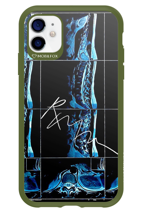 RMN Scolioza 2.0 - Apple iPhone 11